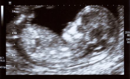First-trimester-screening-1